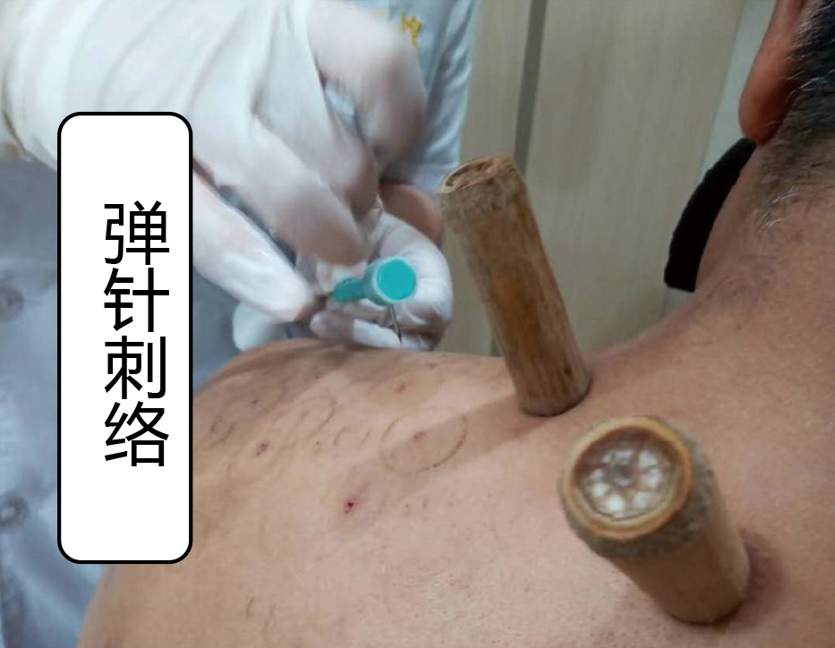 金匱正脊之彈針刺絡篇